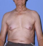 c0270995-gynecomastia-science-photo-library-high_it.jpg