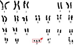 640px-21_trisomy_-_Down_syndrome.png