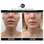 4poze-operatie-lifting-facial-drlevy--1000x1000.jpg 4poze-operatie-lifting-facial-drlevy--1000x1000.jpg