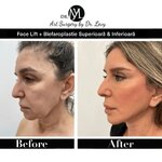 poze-lifting-facial-facelift-dr-levy-60-1000x1000.jpg poze-lifting-facial-facelift-dr-levy-60-1000x1000.jpg