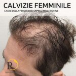 calvizie-femminile-cause.jpg