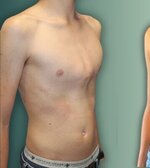 pectus_excavatum_pectus_carinatum_diferencias-1-600x400-3946699363.jpg pectus_excavatum_pectus_carinatum_diferencias-1-600x400-3946699363.jpg